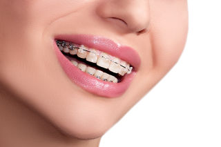 Dra. Grisoski - Brackets Estéticos