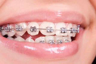 Dra. Grisoski - Brackets Metálicos