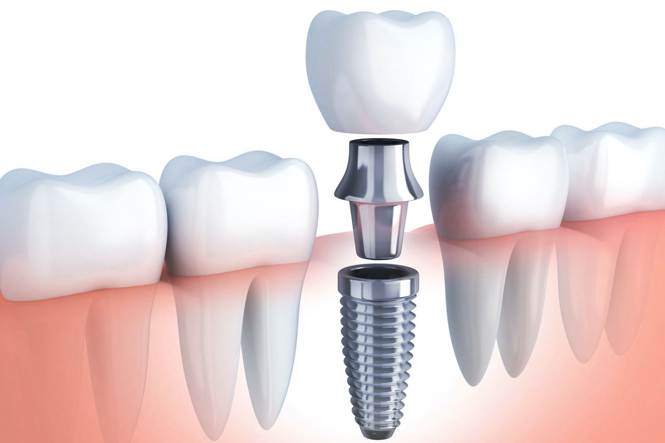 Dra. Grisoski - Cirugía e Implantes